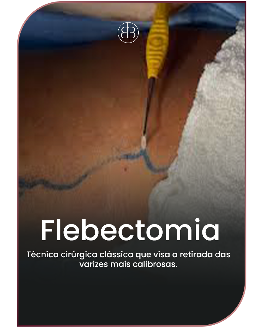 Flebectomia